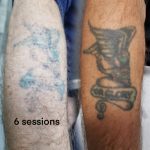 Tattoo laser removal shrewsbury