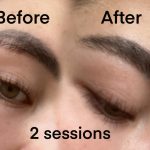 Tattoo laser removal shrewsbury