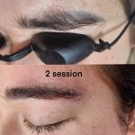 Tattoo laser removal shrewsbury