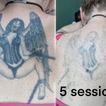 Tattoo laser removal shrewsbury