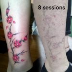 Tattoo laser removal shrewsbury