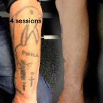 Tattoo laser removal shrewsbury