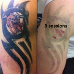 Tattoo laser removal shrewsbury