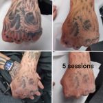 Tattoo laser removal shrewsbury