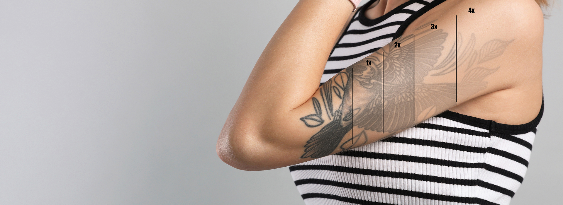 Tattoo Laser Removal Shrewsbury