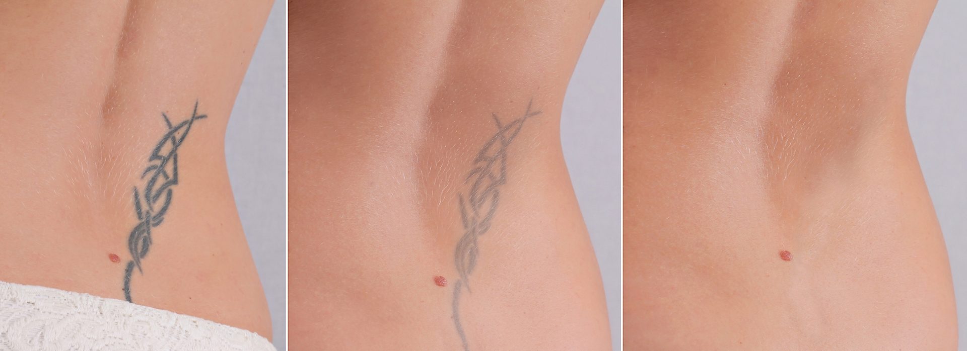 Laser tattoo removal before and after. Beautiful young woman with tattoo on her back