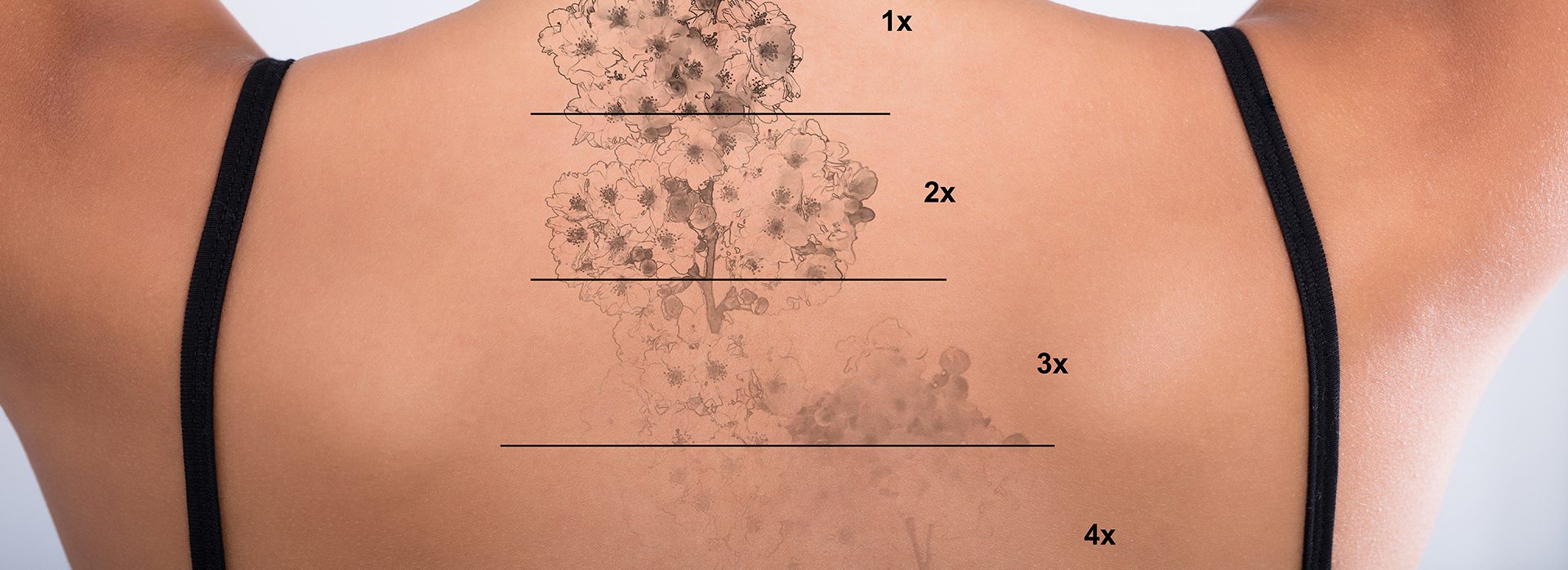 Laser tattoo removal before and after. Beautiful young woman with tattoo on her back