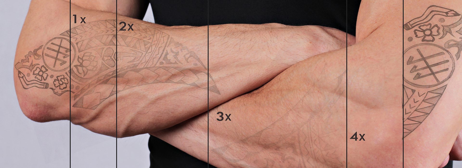 Laser tattoo removal before and after. Attractive Man with tattoo on his hand skin
