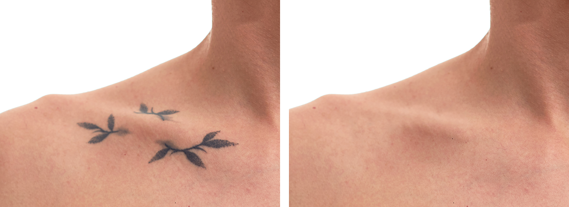 Laser tattoo removal before and after. Beautiful young woman with tattoo on her back